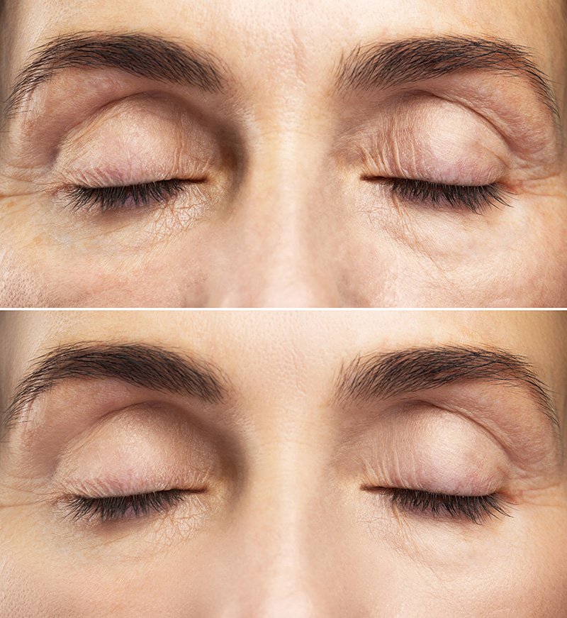 Blefaroplastia